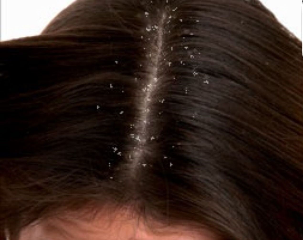 Seborrheic dermatitis (including dandruff)